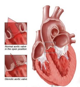 aortic-stenosis