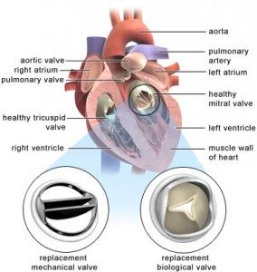 heart-valve-replacement-mitral-284x300