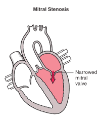 mitral-valve-stenosis