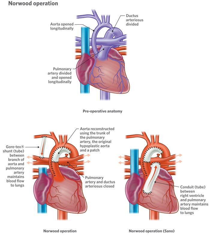 Neonatal Cardiac Surgery| Dr Sajan Koshy Pediatric Heart Surgeon Kochi ...